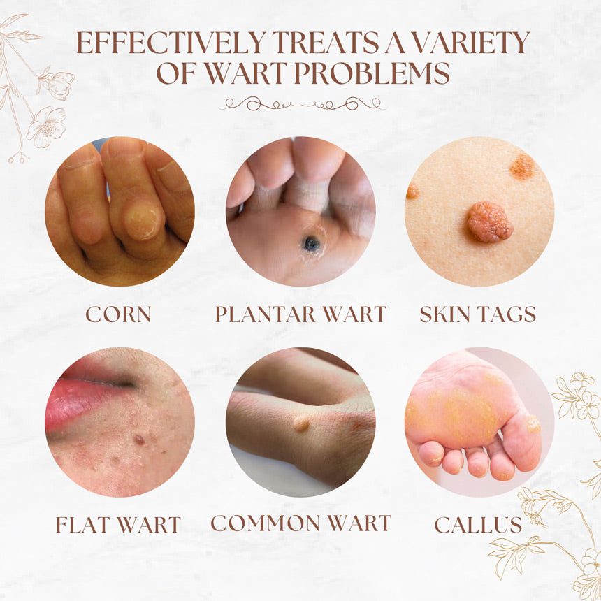 Fast-Acting Liquid Wart Remover